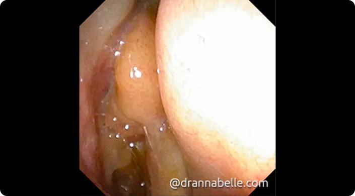 Nasal polyps with a slightly yellowish or greyish grape-like appearance